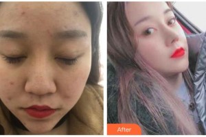 溧陽智多星醫(yī)療美容門診部宋海濤整形價格表附鼻修復(fù)案例展示