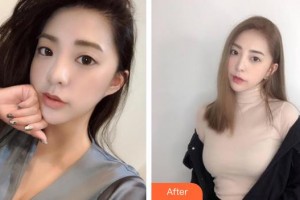 成武縣人民醫(yī)院醫(yī)學(xué)美容科張凌云整形價格表附鼻部綜合案例展示