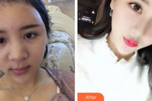 太倉仁慈醫(yī)院整形美容中心朱立群整形價格表附肋軟骨隆鼻案例展示