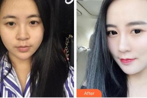 朱云整形價格表附鼻部綜合案例展示