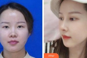 王棟整形價格表附鼻部綜合案例展示