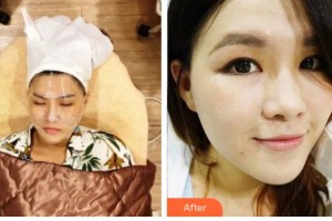 王子誠整形價(jià)格表附激光祛斑案例展示