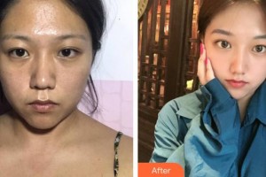 凌宵志整形價(jià)格表附激光祛斑案例展示