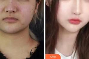 金英整形價(jià)格表附埋線提升案例展示