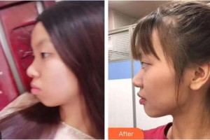 刑曉建整形價(jià)格表附金屬托槽矯正案例展示