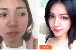 袁鹿鹿整形價(jià)格表附鼻部綜合案例展示