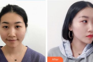 陳鳳霞整形價(jià)格表附肋軟骨隆鼻案例展示