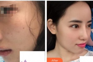 余慧云整形價(jià)格表附鼻部綜合案例展示