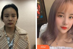 永安茜茜科美醫(yī)療美容門診部余琦整形價(jià)格表附鼻部綜合案例展示