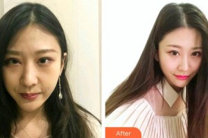 深圳杏雙醫(yī)療美容醫(yī)院王志國整形價(jià)格表附鼻部綜合案例展示