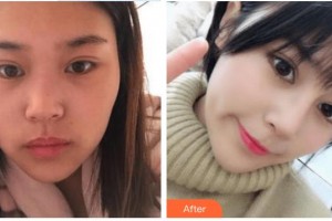 富陽韓加醫(yī)療美容門診部宋建良整形價(jià)格表附鼻部綜合案例展示