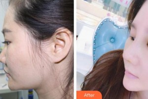 王旭彬整形價(jià)格表附鼻部綜合案例展示