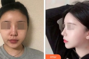 張立春整形價(jià)格表附鼻部綜合案例展示