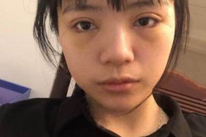 廈門(mén)海峽整形醫(yī)院雙眼皮果？附果圖及案例展示