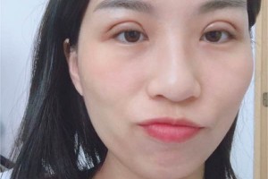 浙江嘉興榮軍醫(yī)院環(huán)境怎么樣割雙眼皮日記|價格表