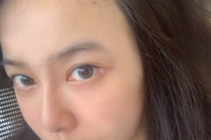 洛陽150醫(yī)院整形科植發(fā)項目怎么樣附圖片對比