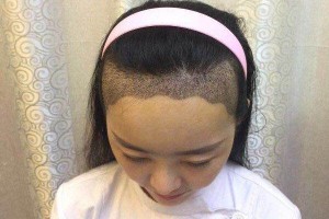 ?？谑腥嗣襻t(yī)院植發(fā)怎樣附果圖