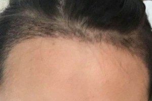 北京同仁醫(yī)院整形美容外科怎么樣？（附果圖）