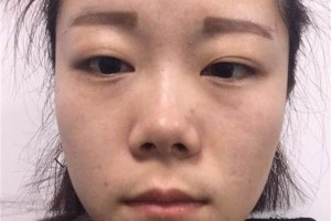 玉林市一醫(yī)院美容科激光怎么樣附果圖