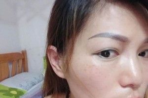 武漢同濟(jì)醫(yī)院激光怎么樣附果圖