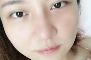 武漢亞太整形隆鼻怎么樣？真人案例+醫(yī)生介紹