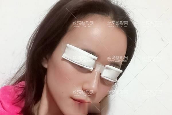 寧波113整形美容醫(yī)院？雙眼皮3個(gè)月果|整形專家詳情