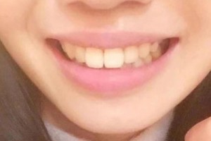 賽德陽(yáng)光口腔醫(yī)院怎么樣/y牙齒矯正案例分享