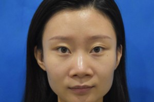 空軍總醫(yī)院隆鼻的費(fèi)用？2021費(fèi)用表+醫(yī)生推薦