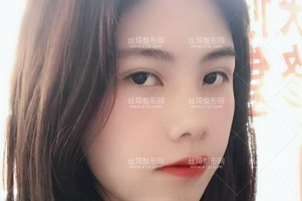 上海九院怎么樣？雙眼皮3個(gè)月果|整形專家詳情