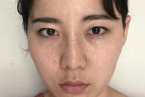 浙一激光美容科？真人實(shí)拍對(duì)比&費(fèi)用表