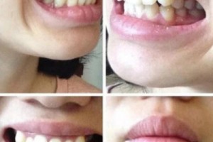 西安中諾口腔醫(yī)院評價(jià)？牙齒矯正成功案例分享！