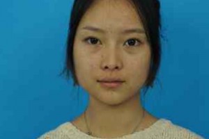 濟南華僑醫(yī)院雙眼皮咋樣？醫(yī)生技術(shù)如何/費用表