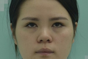 南京鼓樓醫(yī)院激光價(jià)格表—案例對(duì)比圖