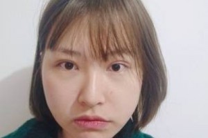 無(wú)錫二院的美容科好嗎？假體隆鼻術(shù)后恢復(fù)|價(jià)格表