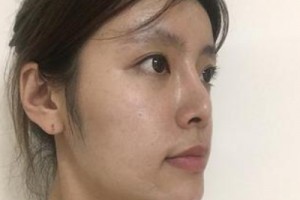 京民整形醫(yī)院假體隆鼻靠譜嗎？親身經(jīng)歷分享&對(duì)比圖