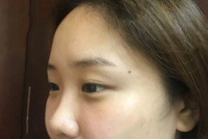 武漢協(xié)和醫(yī)院美容科怎么樣 ？去眼袋果圖