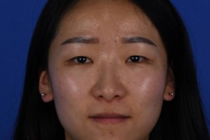 上海伊萊美容醫(yī)院口碑怎么樣？雙眼皮案例對(duì)比圖