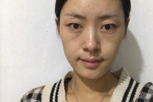 洛陽華美整形美容醫(yī)院怎么樣？激光去皺好不好？