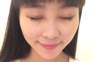 臨沂市人民醫(yī)院雙眼皮怎么樣？注意事項(xiàng)+術(shù)前準(zhǔn)備必看