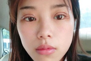 長沙亞韓整形醫(yī)院雙眼皮價(jià)格？術(shù)后幾點(diǎn)需注意！