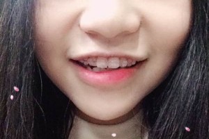 江蘇邳州口腔靠譜嗎？牙齒矯正的價(jià)格表!