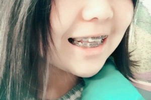 四川華西口腔醫(yī)院？牙齒矯正術(shù)后分享！