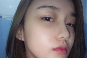 廣州軍區(qū)總醫(yī)院整形科好不好|下頜角手術(shù)日記&價格表