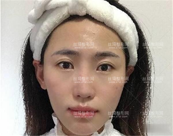 上海第九人民醫(yī)院整形怎么樣？隆鼻案例圖|價格費用