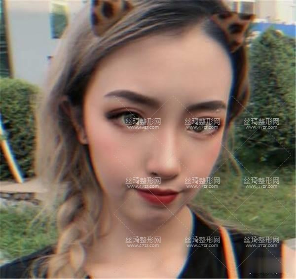 304醫(yī)院整形美容科怎么樣隆鼻3個(gè)月果|整形專家詳情