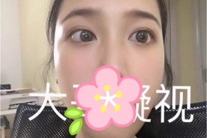 成都西嬋整形醫(yī)院雙眼皮術(shù)后恢復(fù)記錄！快看