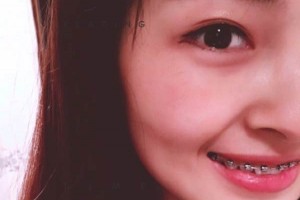 西安中諾口腔牙齒矯正價(jià)目表—術(shù)后護(hù)理分享