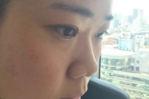 成都恩喜整形醫(yī)院膨體隆鼻正規(guī)嗎？醫(yī)生推薦