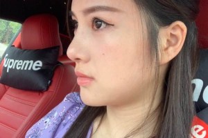 上海九院整形科/下頜角真實案例實拍