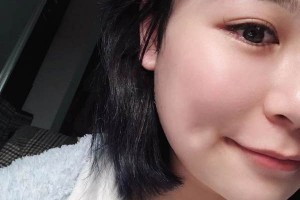 安醫(yī)二附院整形外科下頜角怎么樣？成功案例測評！